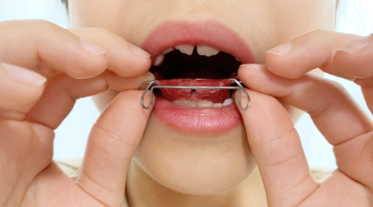 お子様の予防矯正を行っています。